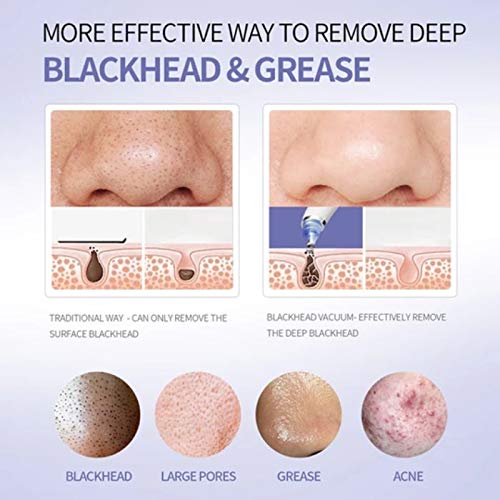 Derma Suction Vacuum Blackhead Remover
