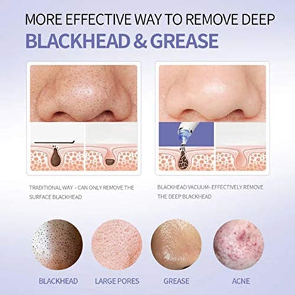 Derma Suction Vacuum Blackhead Remover